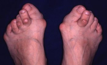 リウマチ足モデル１