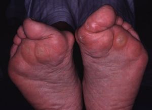 リウマチ足モデル２