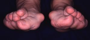 リウマチ足モデル３