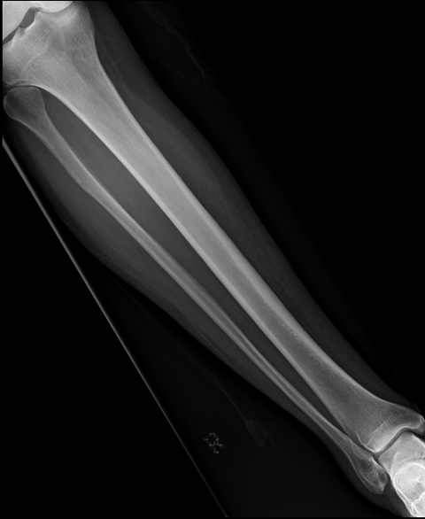 tibia-ap1