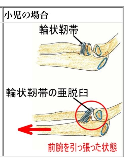 肘内障 ちゅうないしょう ムルコブログ 肘内障 ちゅうないしょう ムルコブログ