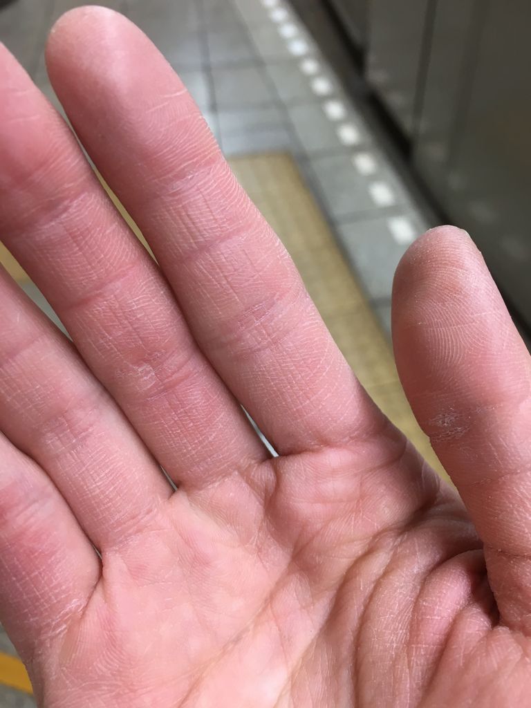 荒れまくりの汚い手に悲しくなる豚 はっちの蒸し豚