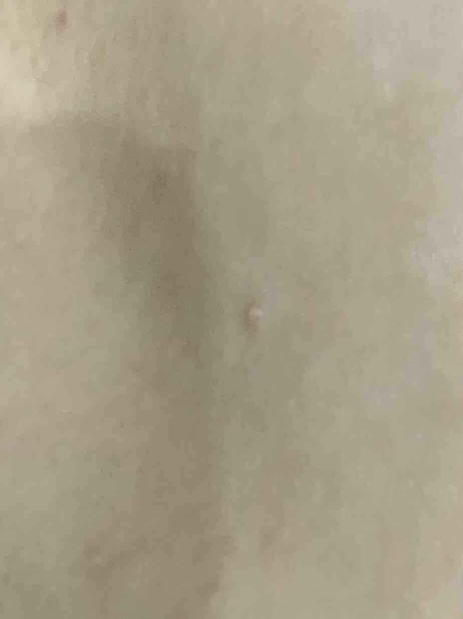 4歳息子の水いぼ治療 3日目 迷える主婦の個性強めの家族の日記