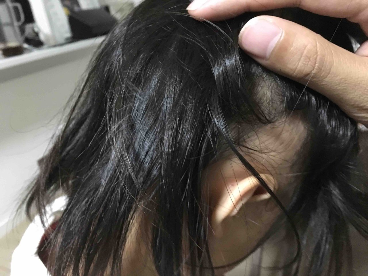 娘の円形脱毛症治療日記 Mizlog