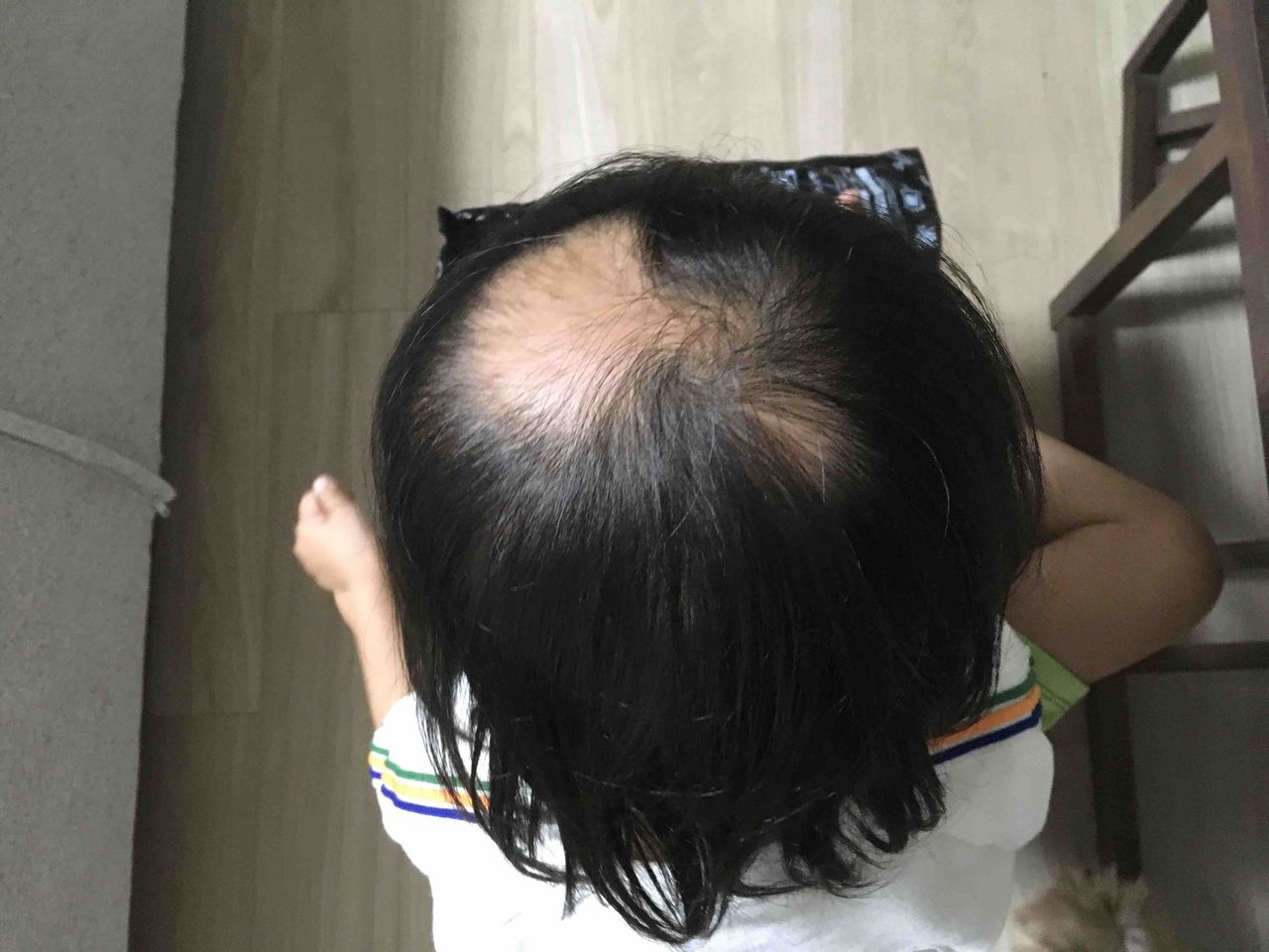 娘の円形脱毛症治療日記 Mizlog