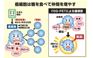 PET-CT 悪性リンパ腫③