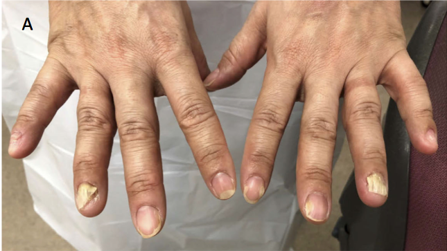 42歳男性 爪が剥がれる 今日なに読もう 病院総合診療医の論文ブログ