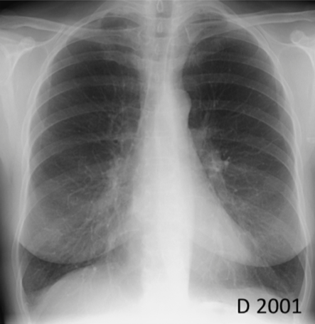 73歳女性 胸痛 今日なに読もう 病院総合診療医の論文ブログ