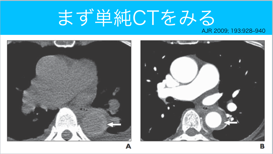 大動脈解離についてレクチャーしました 今日なに読もう 病院総合診療医の論文ブログ 大動脈解離についてレクチャーしました 今日なに読もう 病院総合診療医の論文ブログ