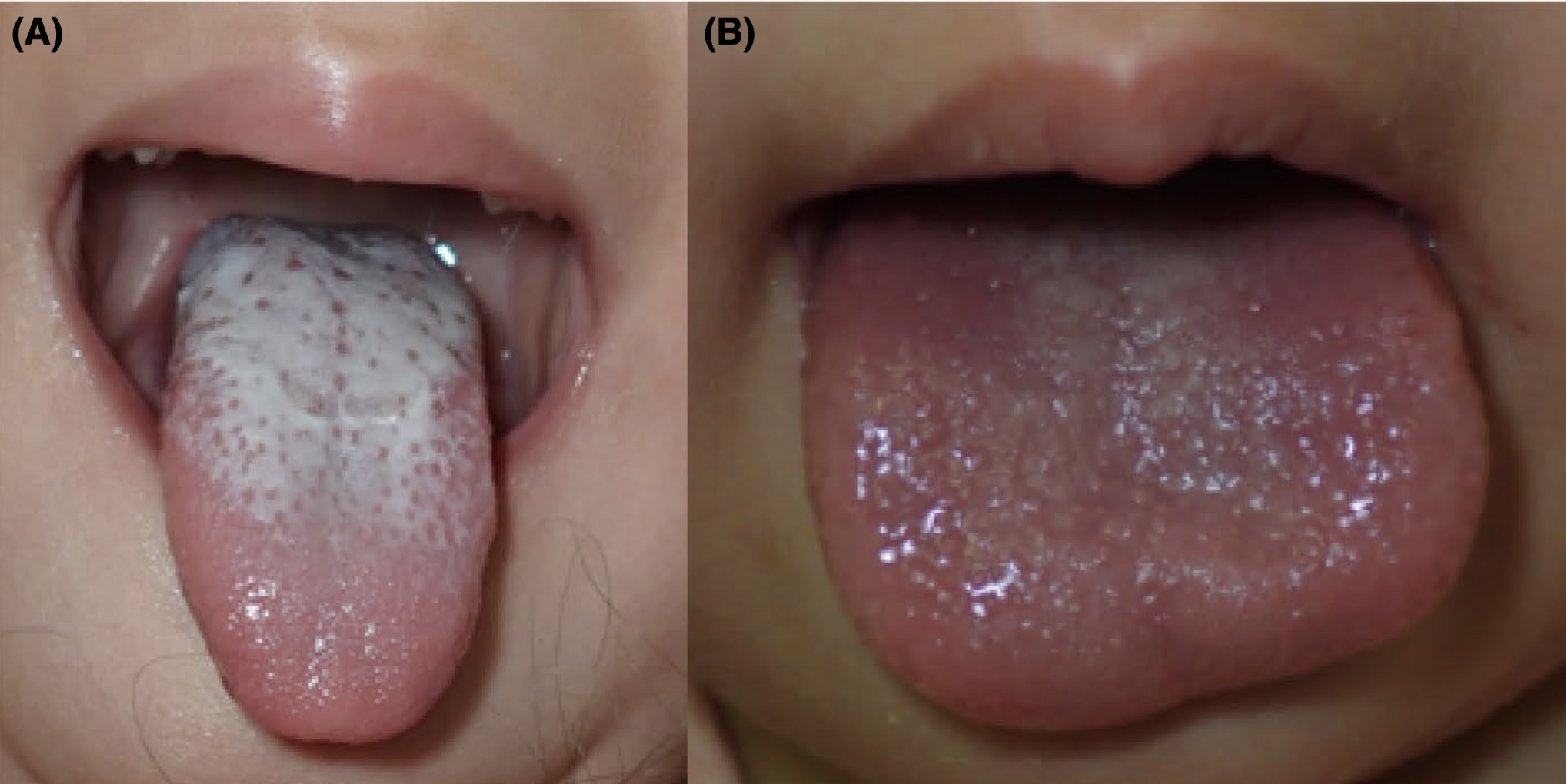 Toxic shock syndromeのStrawberry tongue : 今日なに読もう〜病院総合 