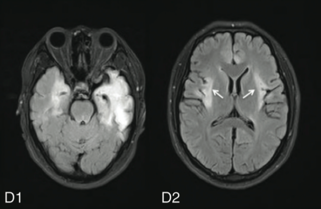 抗nmda受容体抗体脳炎の頭部mriの病変部位 今日なに読もう 病院総合診療医の論文ブログ