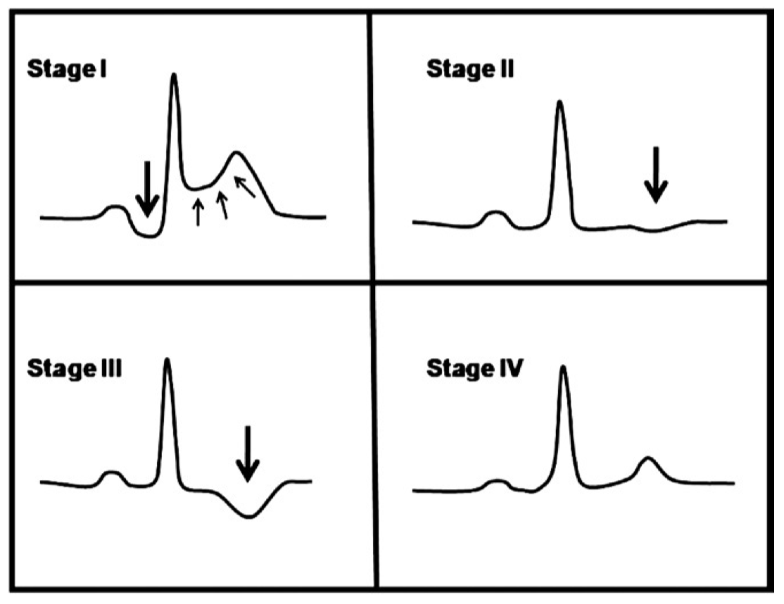 急性心膜炎のPR低下とSpodick’s Sign : 今日なに読もう〜病院総合診療医の論文ブログ〜