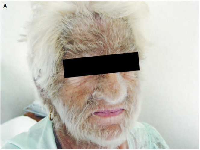 68歳女性 全身の毛が増えた 今日なに読もう 病院総合診療医の論文ブログ 68歳女性 全身の毛が増えた 今日なに読もう 病院総合診療医の論文ブログ