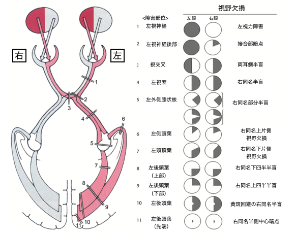 視放線障害 – 目の見え方がおかしい 脳 – NDJI