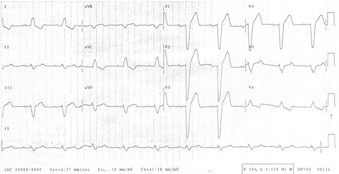 Left-bundle-branch-block-LBBB-4