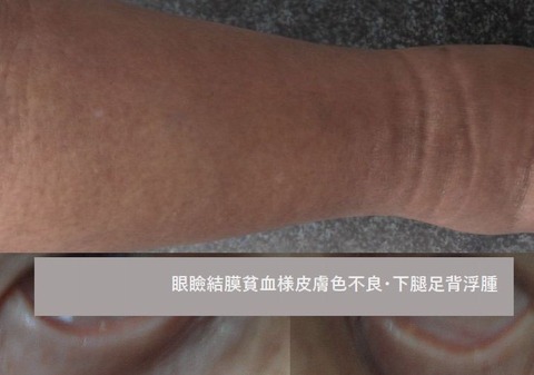 edema