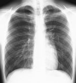 2026.3.19oneumothorax0000
