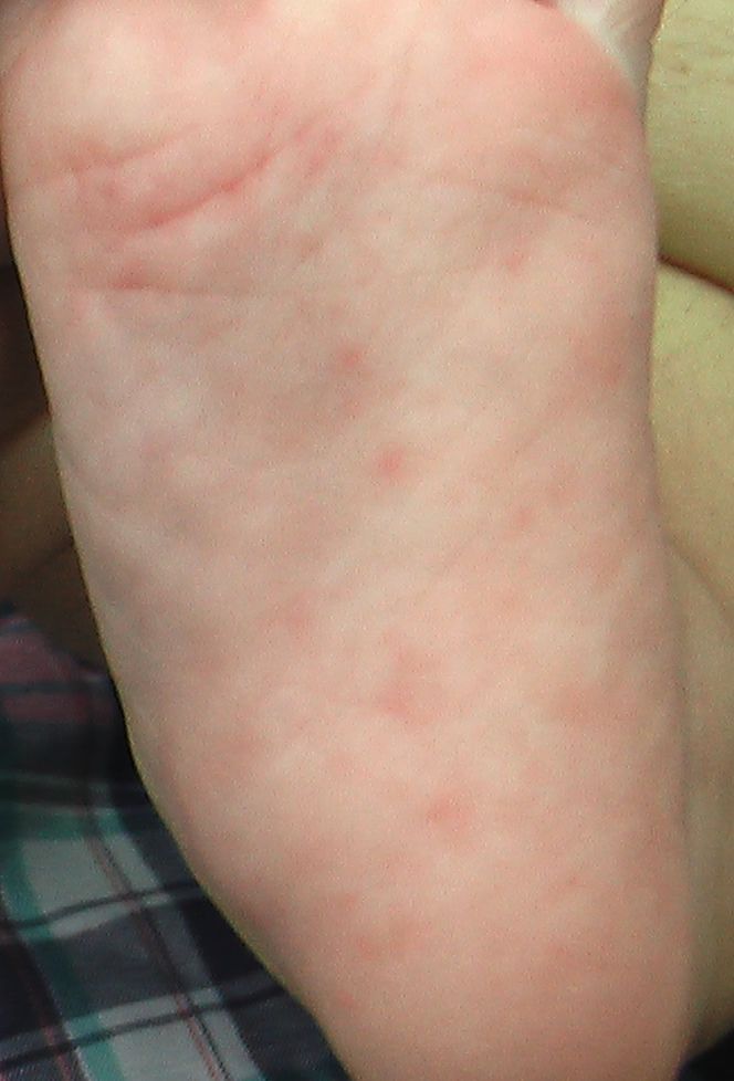 手足口病 2ヶ月 19 こどもの病気 おとなの病気