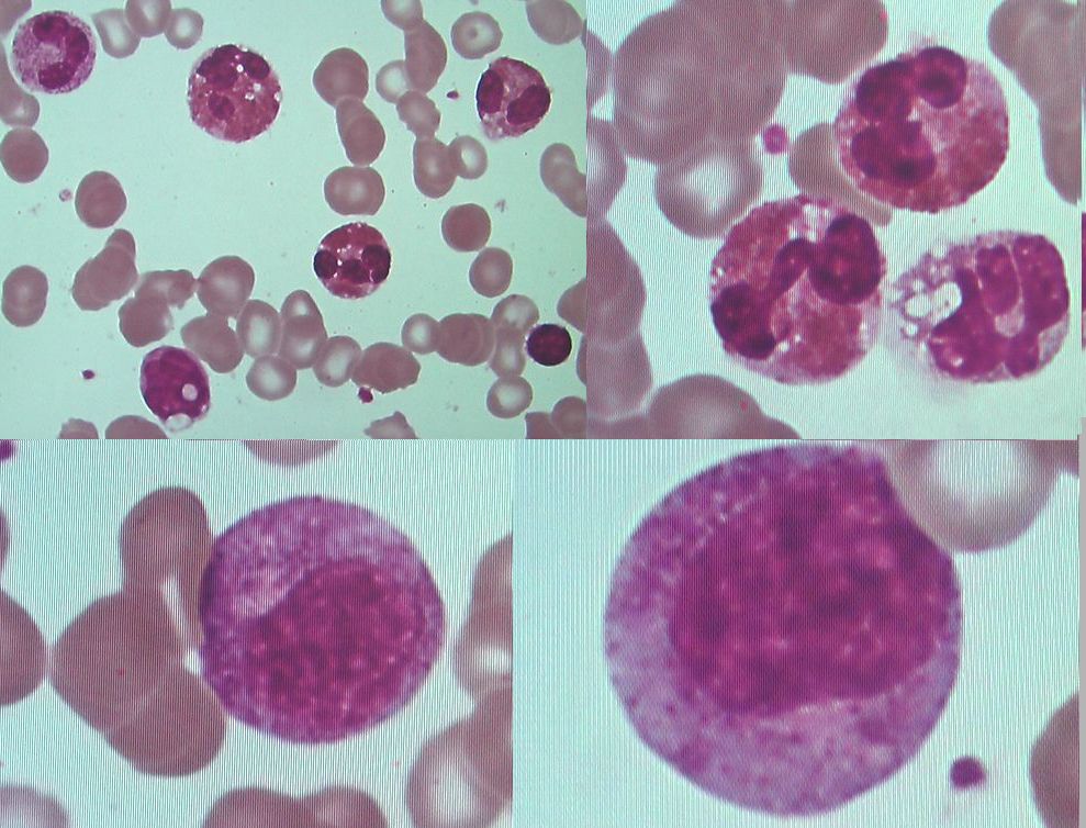 こどもの病気・おとなの病気慢性好酸球性白血病(CEL)
