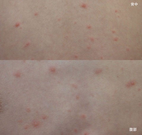 varicella