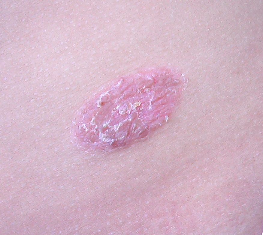 乾癬or湿疹の苔癬化 こどもの病気 おとなの病気