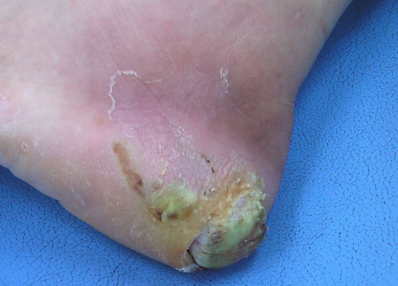 糖尿病(足病変)(1) : こどもの病気・おとなの病気