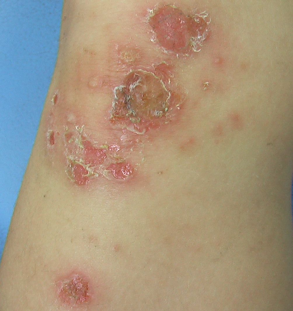 こどもの病気・おとなの病気伝染性膿痂疹(6)