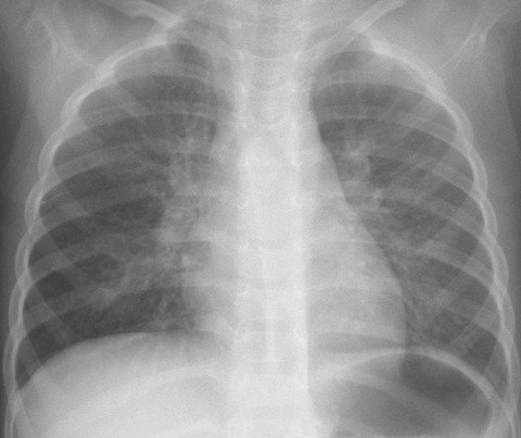 2026.3.13adenopnemonia0000