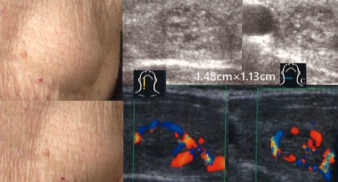 tumor (2)