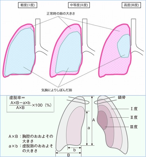 こどもの病気・おとなの病気:自然気胸