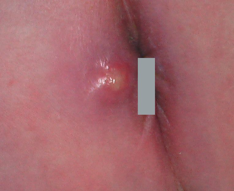肛門周囲膿瘍 1ヶ月 こどもの病気 おとなの病気