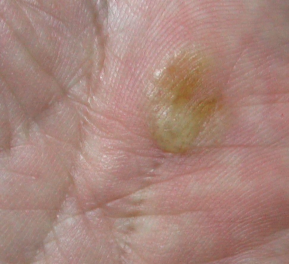 汗疱 こどもの病気 おとなの病気