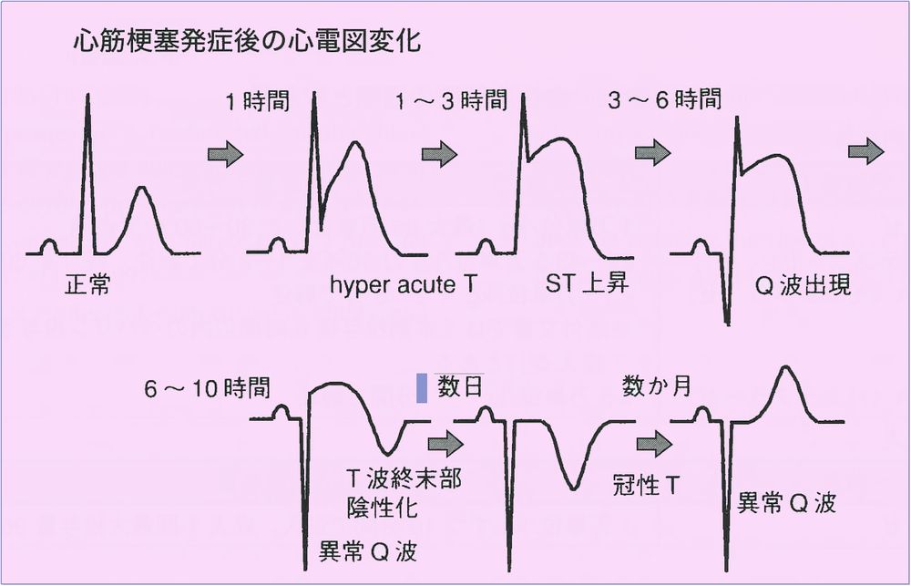心筋梗塞疑 ラピチェック偽陽性 異型狭心症 こどもの病気 おとなの病気