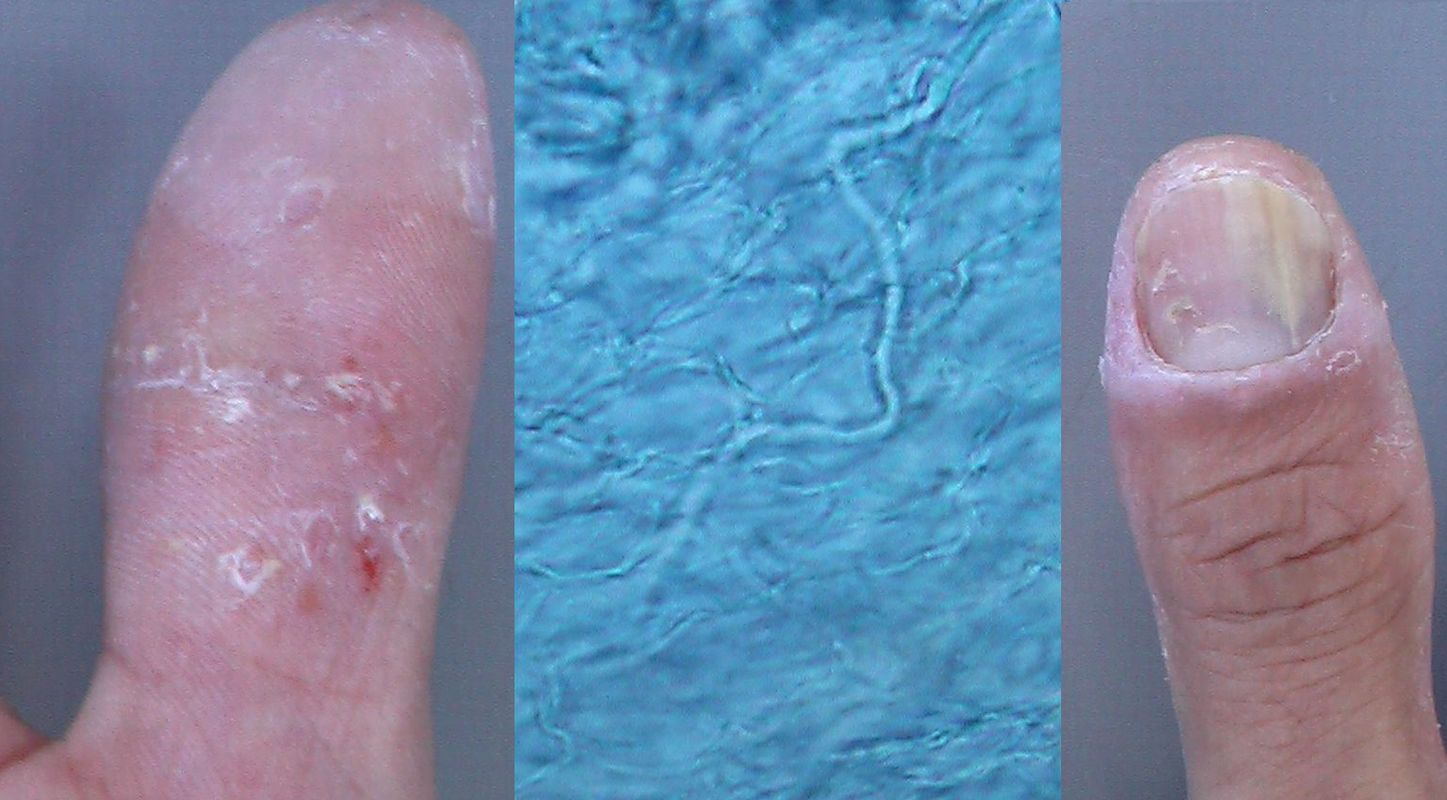 手白癬 こどもの病気 おとなの病気 手白癬 こどもの病気 おとなの病気