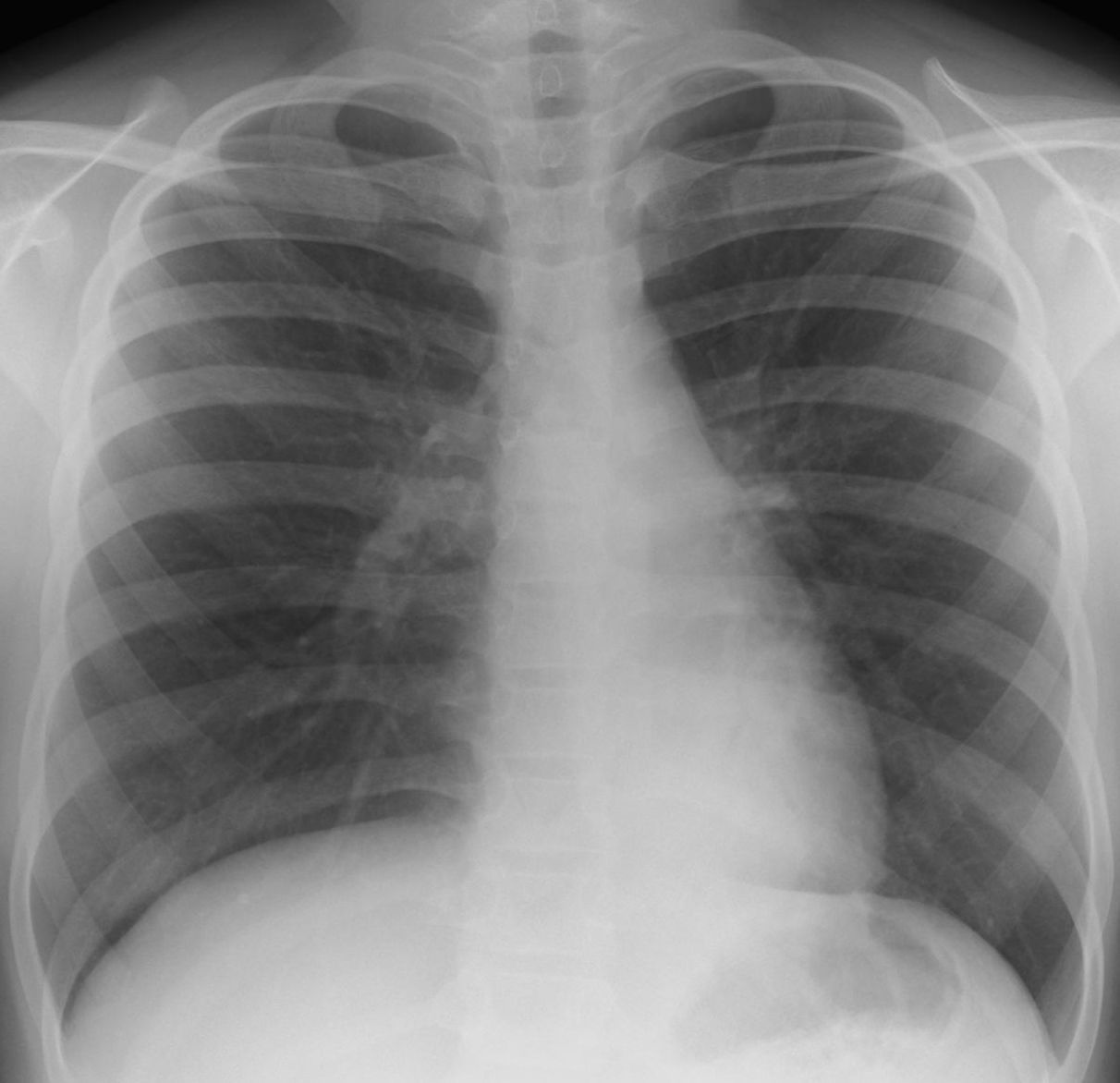 こどもの病気・おとなの病気ウイルス性肺炎(インフルエンザB)(学童)