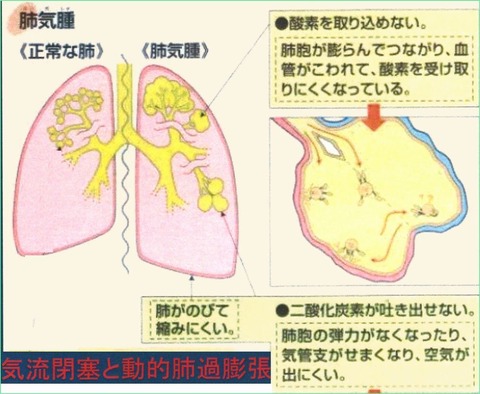 emphysema