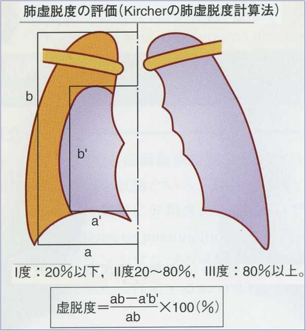こどもの病気・おとなの病気:気胸(4)