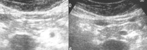 pancres