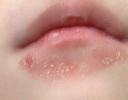 舌なめずり皮膚炎 2 こどもの病気 おとなの病気