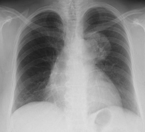 2026.3.2lymphoma0000