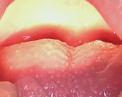 溶連菌感染症 24 苺舌 発疹 こどもの病気 おとなの病気 溶連菌感染症 24 苺舌 発疹 こどもの病気 おとなの病気