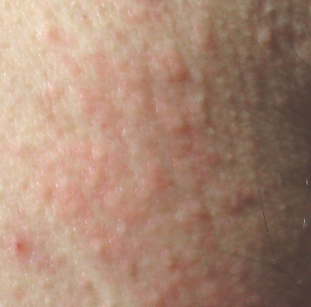 接触皮膚炎 2 こどもの病気 おとなの病気