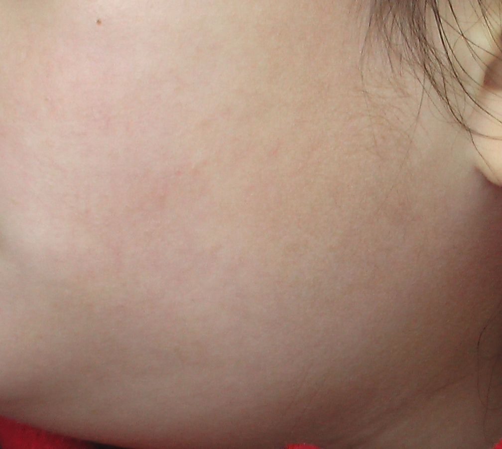 流行性耳下腺炎 6 顎下腺腫脹 こどもの病気 おとなの病気