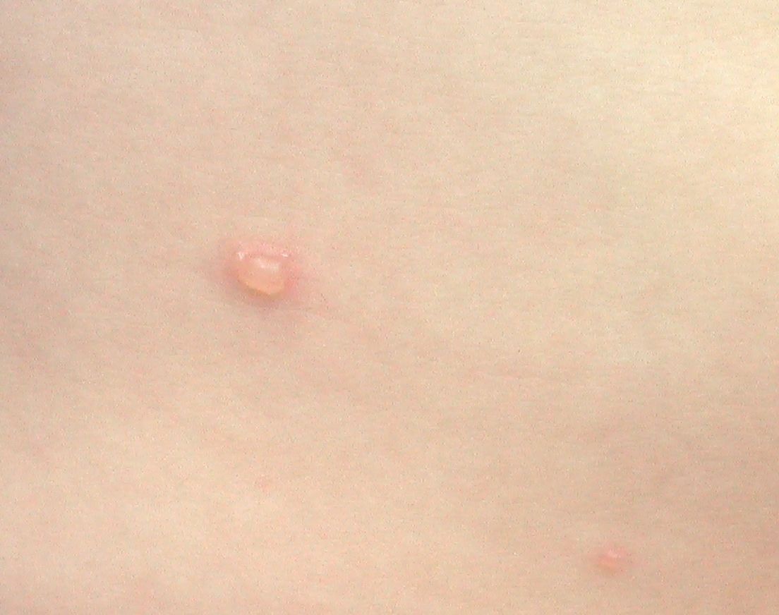 水痘 14 初期の水疱 頭部の水疱 こどもの病気 おとなの病気