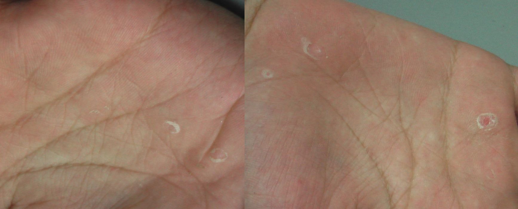 手白癬 こどもの病気 おとなの病気 手白癬 こどもの病気 おとなの病気