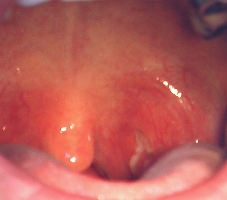 化膿性扁桃腺炎 1 こどもの病気 おとなの病気