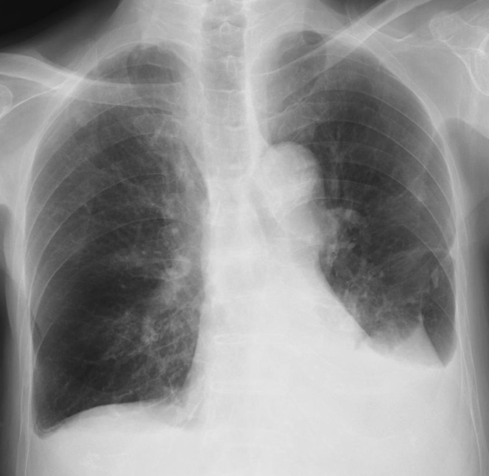 肺炎 無気肺 胸膜炎 こどもの病気 おとなの病気