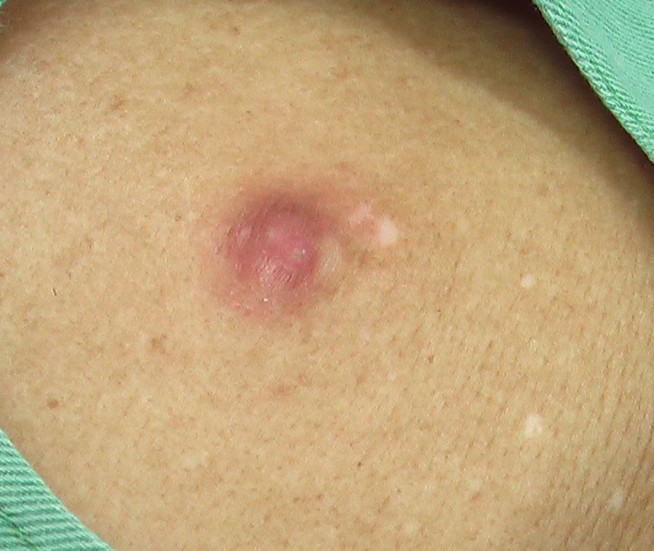 アテロ ム 9 感染性粉瘤 こどもの病気 おとなの病気