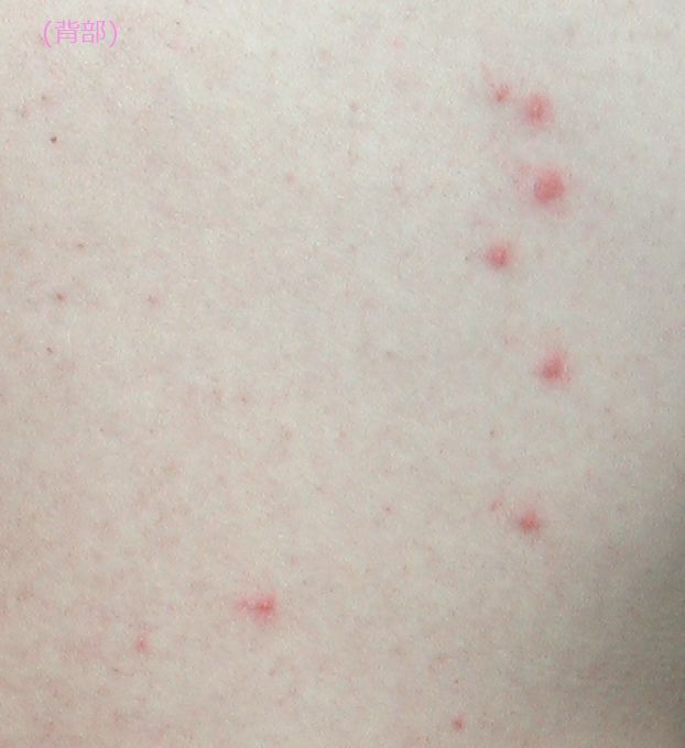 接触皮膚炎 7 毛虫皮膚炎 こどもの病気 おとなの病気 接触皮膚炎 7 毛虫皮膚炎 こどもの病気 おとなの病気