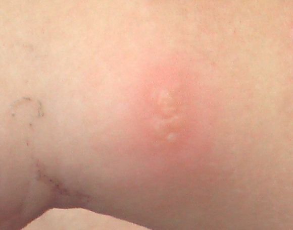 口唇ヘルペス 8 単純性ヘルペス 前腕 こどもの病気 おとなの病気